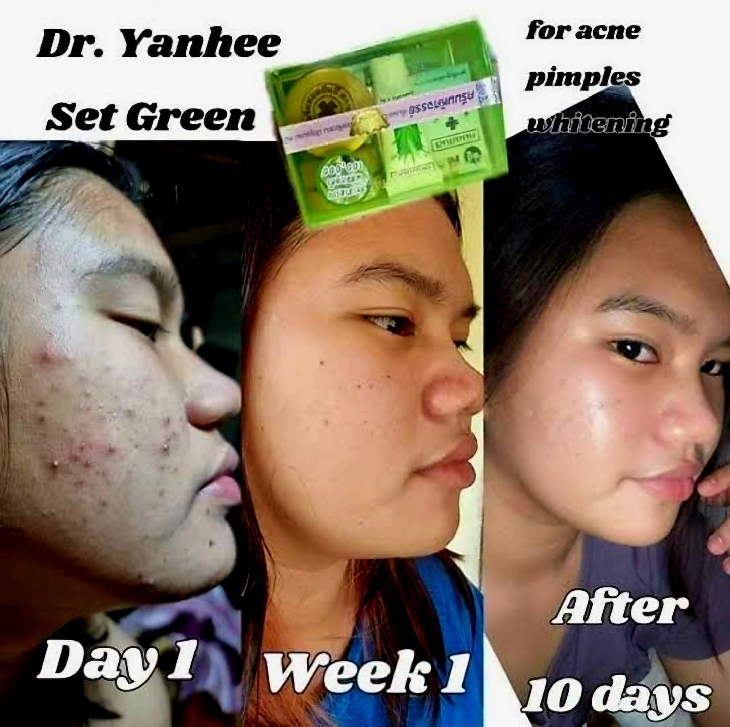 Dr.YAHNEE Anti-Acne Set (GREEN) Acne Remover