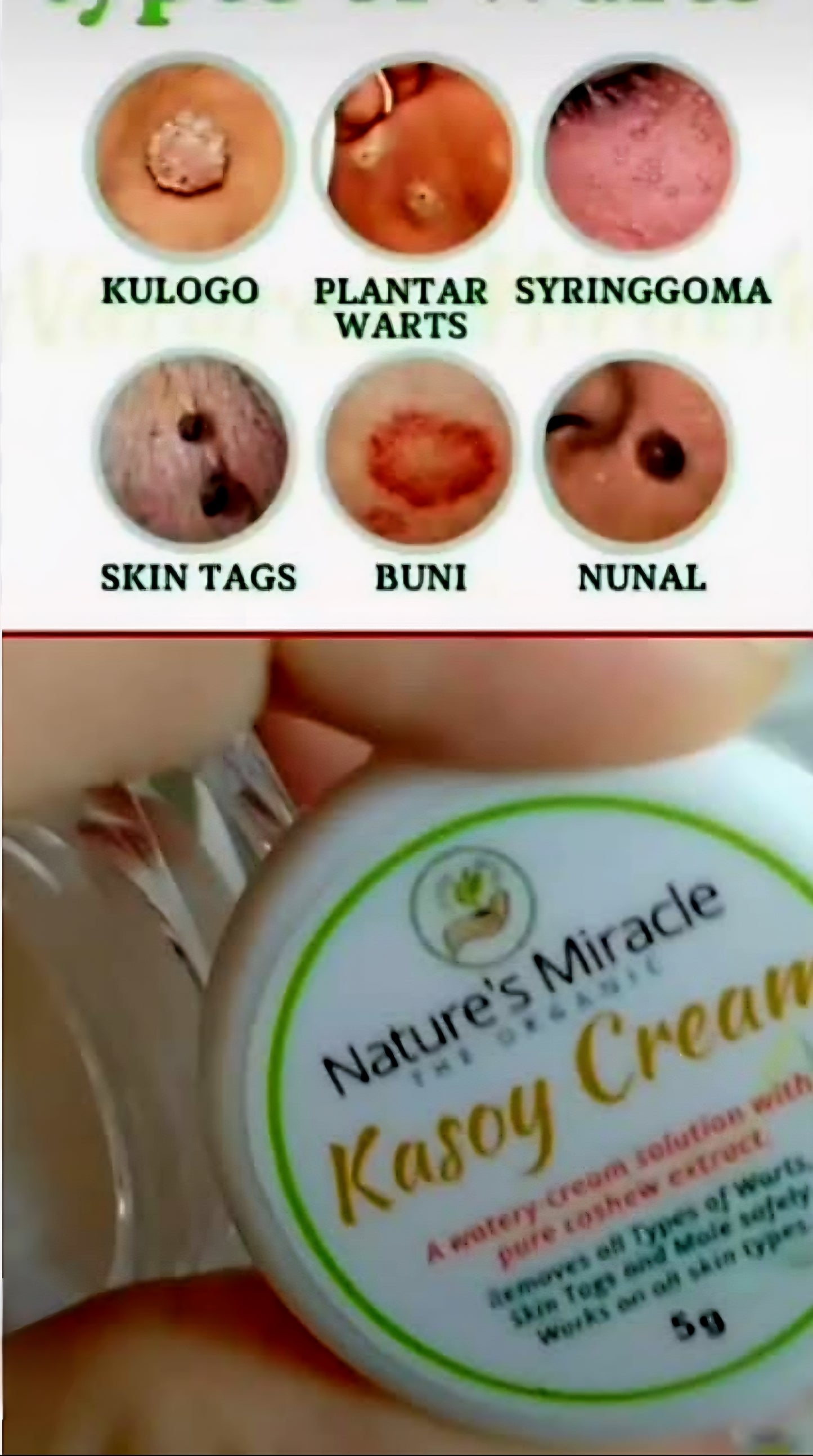 Nature's Miracle KASOY CREAM Warts & Skin Tags Removal 5g