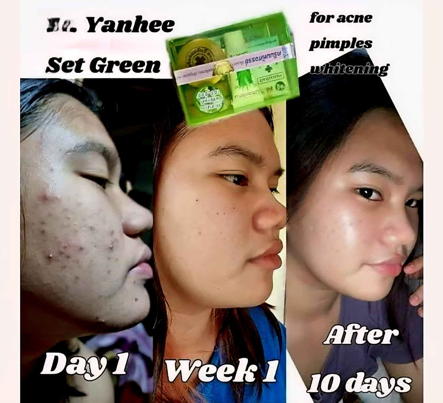 Dr.Yanhee ACNE & PIMPLE TREATMENT Set (GREEN)