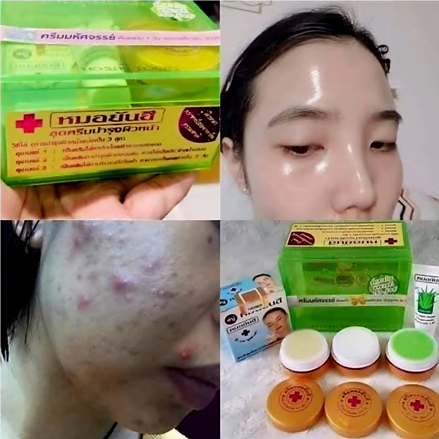 Dr.Yanhee ACNE & PIMPLE TREATMENT Set (GREEN)