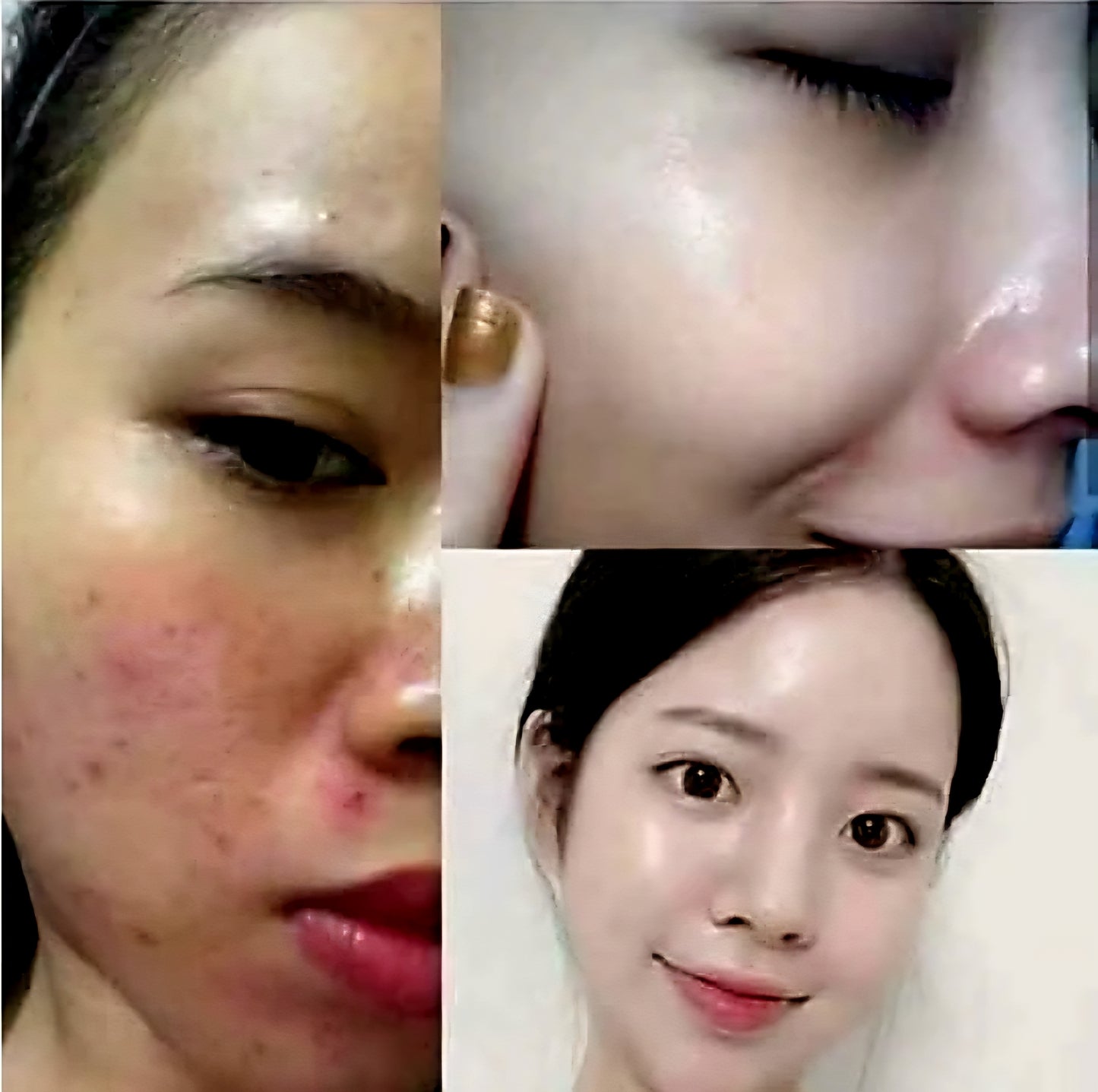 Dr.Yanhee ACNE & PIMPLE TREATMENT Set (GREEN)